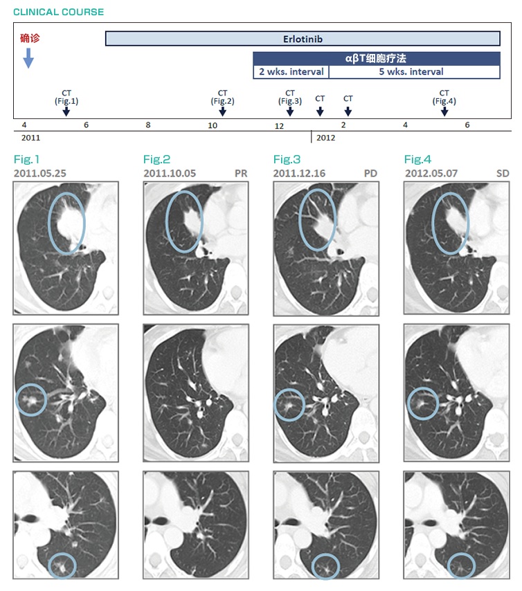 厄洛替尼耐藥后，免疫細胞治療（αβT細胞療法）治療后維持穩定狀態的肺癌(IV期)案例