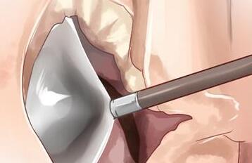 利用自體心包膜的主動(dòng)脈瓣重建手術(shù)