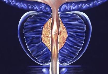 PSMA-PET-CT可顯著提升前列腺癌早期轉移診斷的準確率