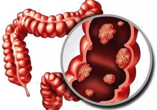 日本順天堂教授談：糞便移植治療潰瘍性結腸炎的研究結果